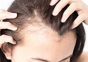 روش های جلوگیری از ریزش مو 